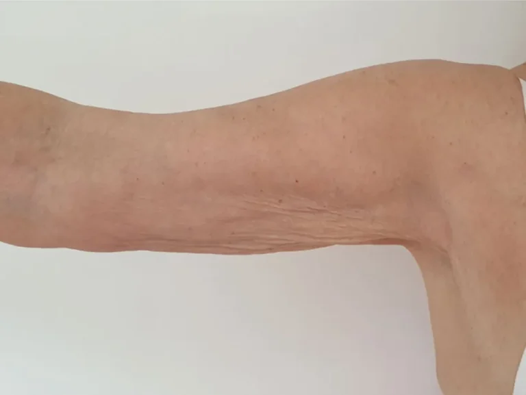 Endoliftlaser pre