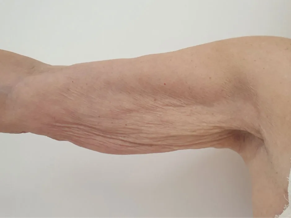 Endoliftlaser pre
