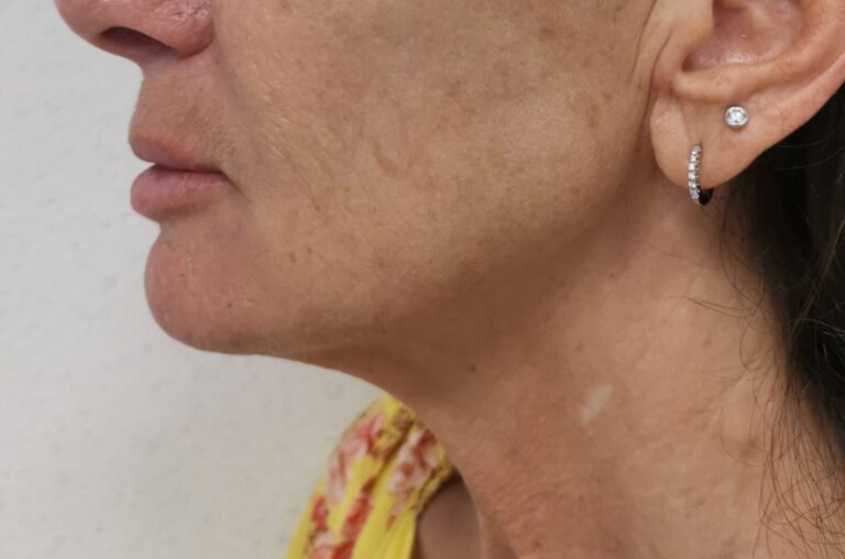 Endoliftlaser1 post