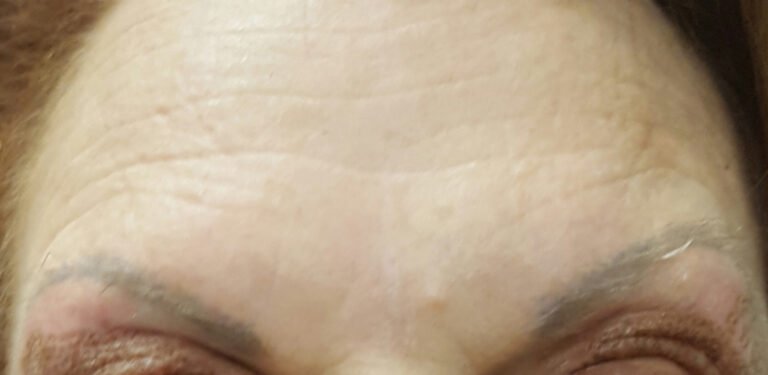 botox post