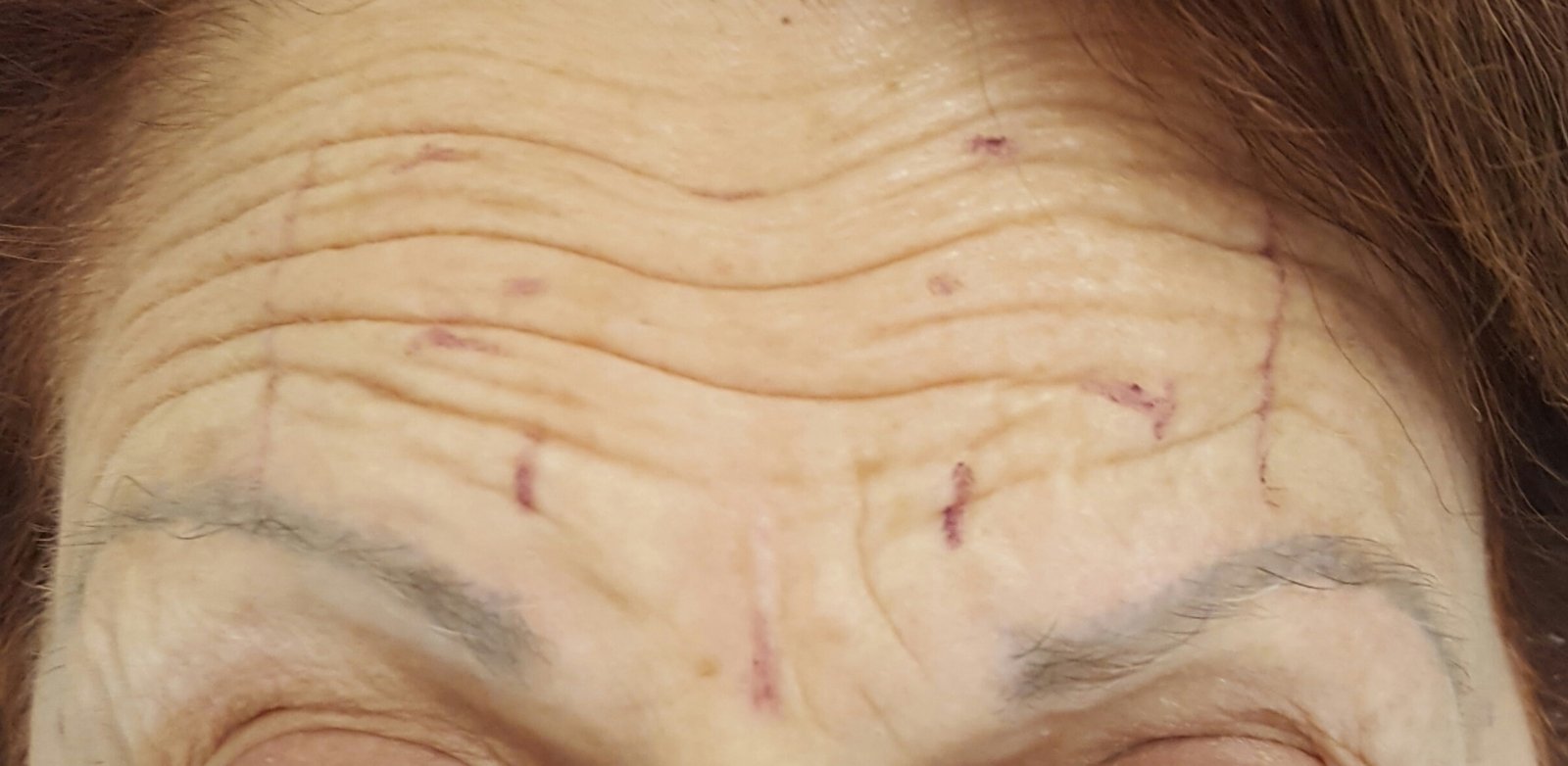 botox pre