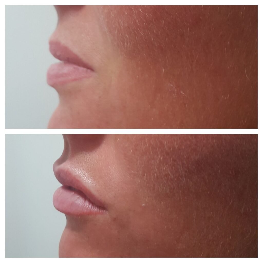 filler labbra 1