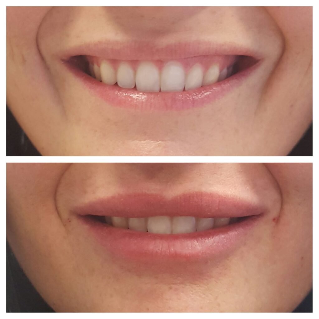 filler labbra 10