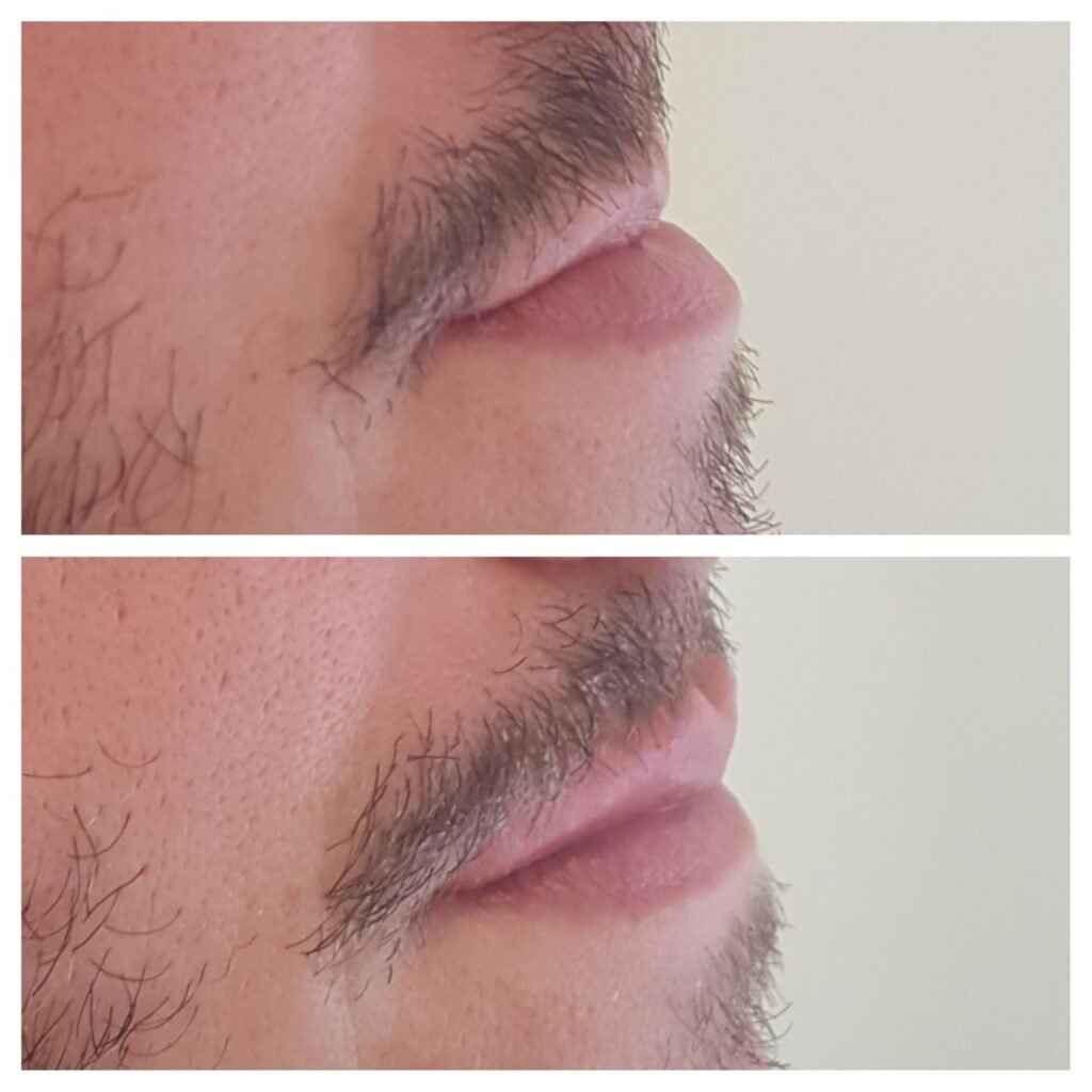 filler labbra 13