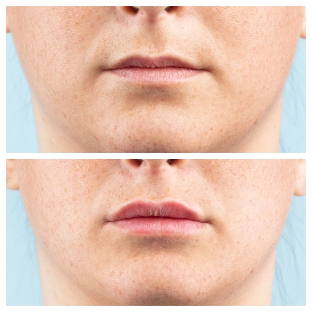 filler labbra 14