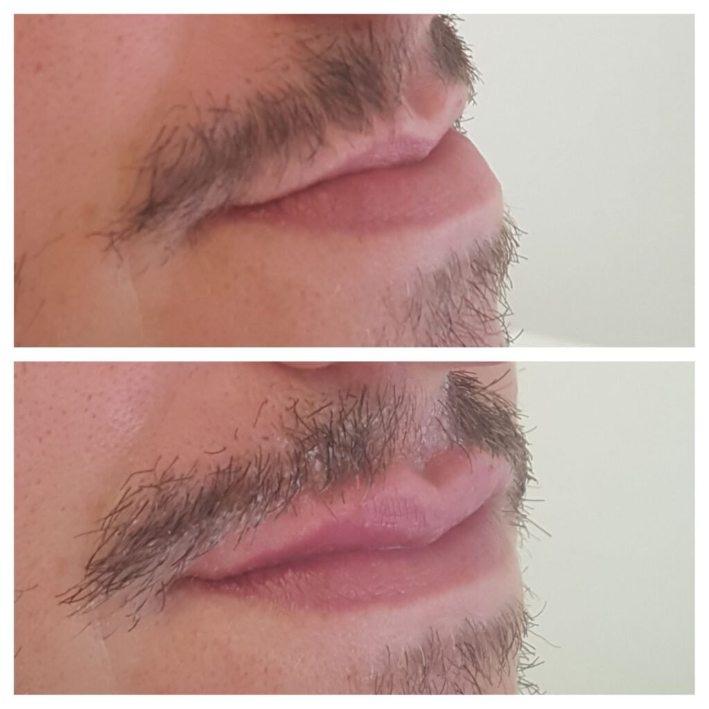 filler labbra 17