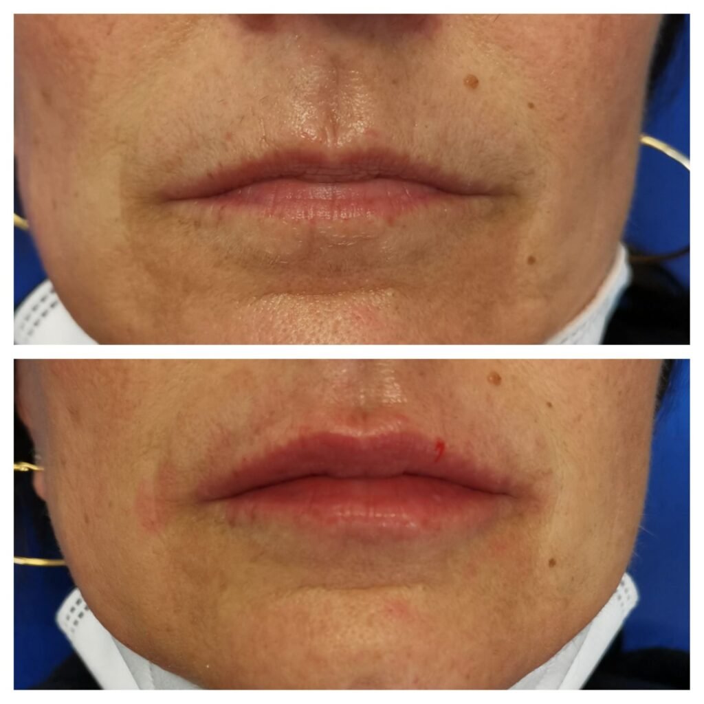 filler labbra 19