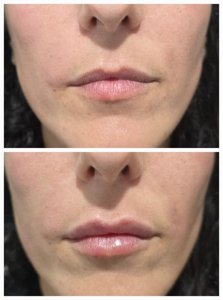 filler labbra 2
