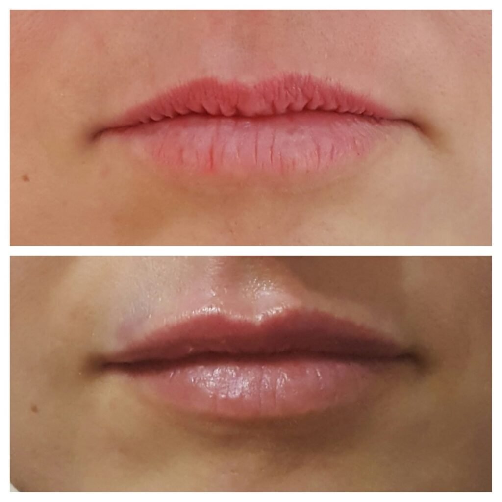 filler labbra 20