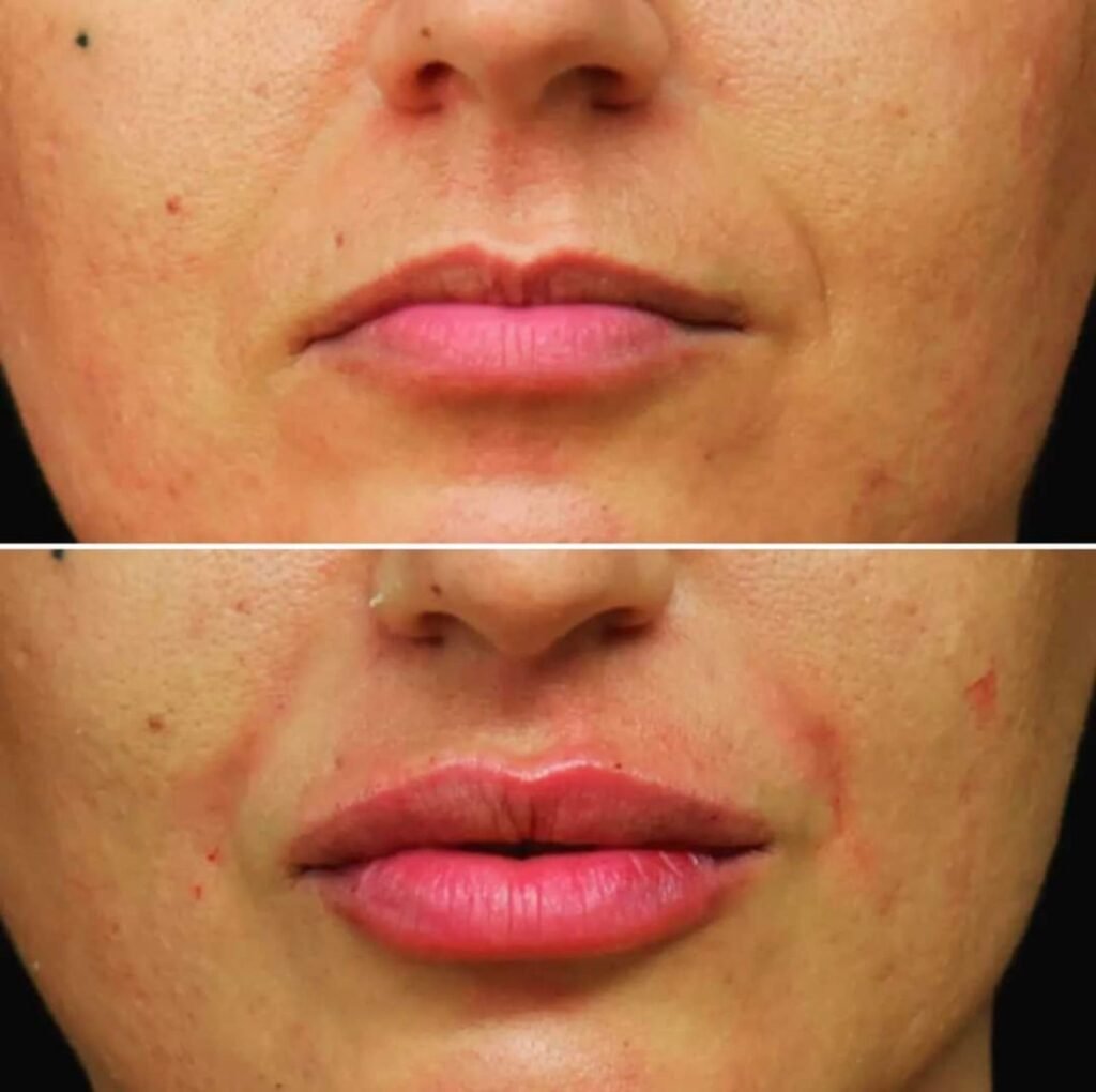 filler labbra 23