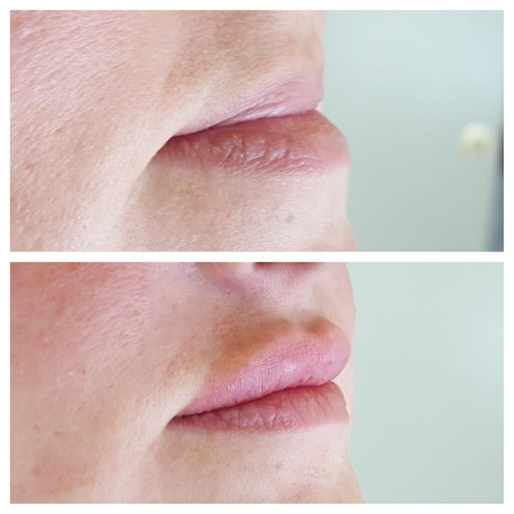 filler labbra 3