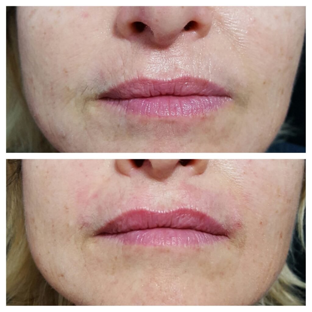 filler labbra 4