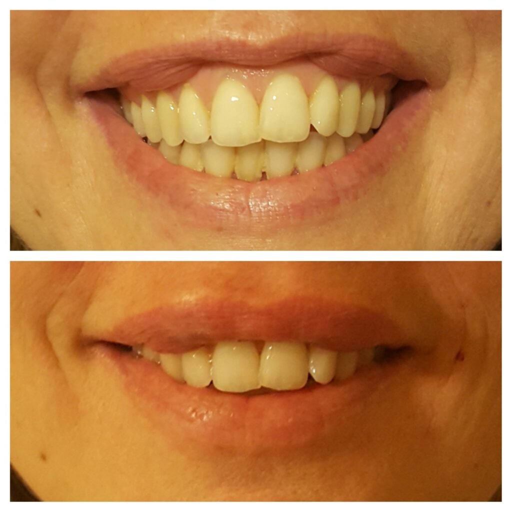 filler labbra 5