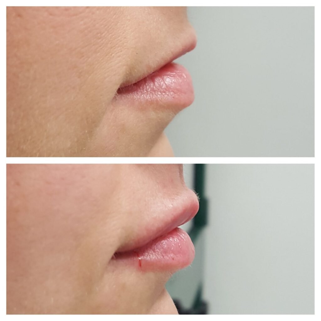 filler labbra 6