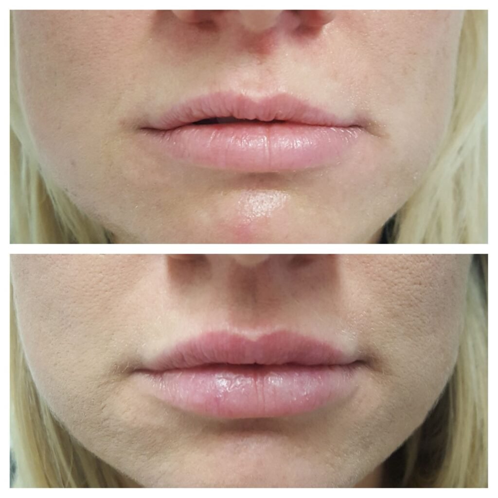 filler labbra 8