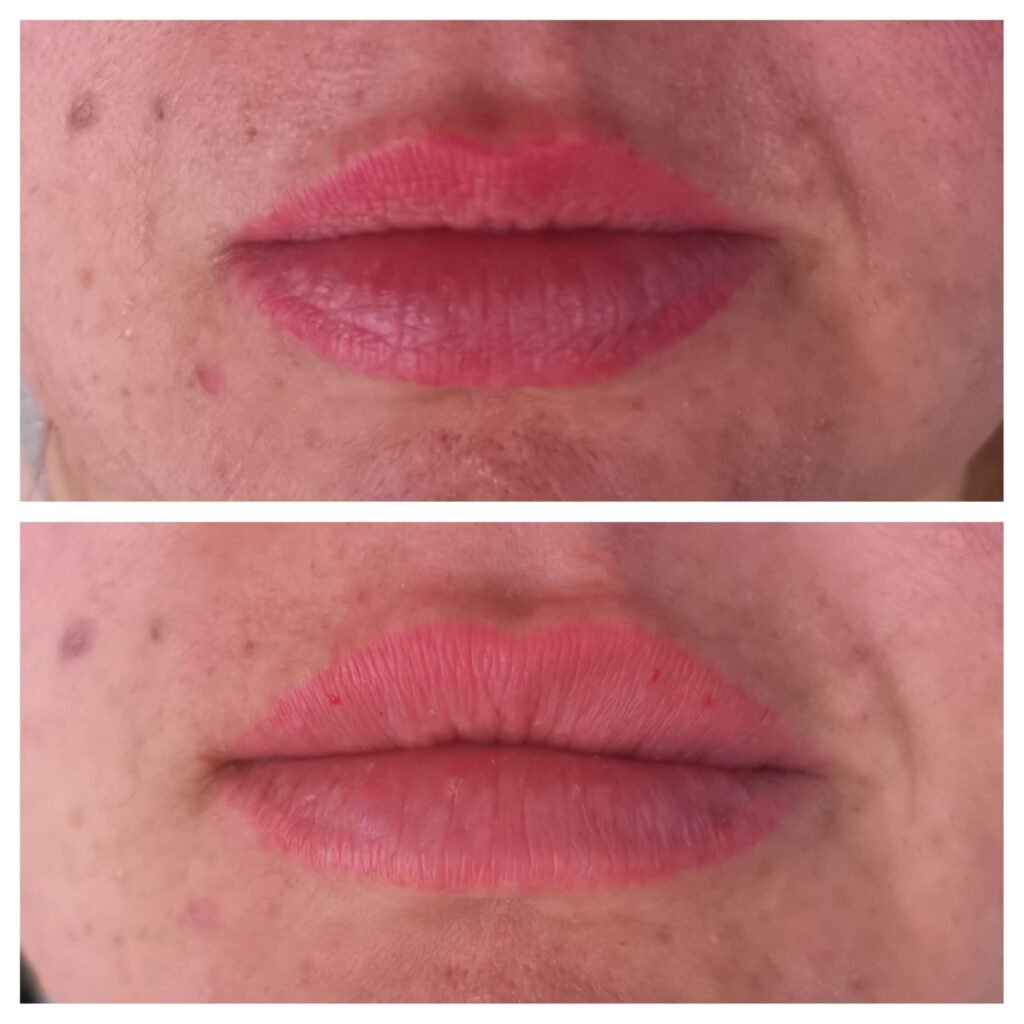 filler labbra 9