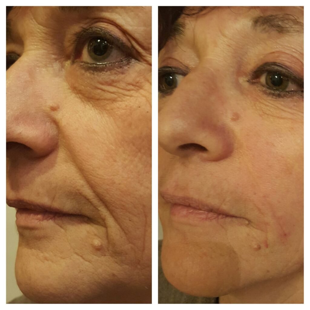filler solchi nasogenieni 1