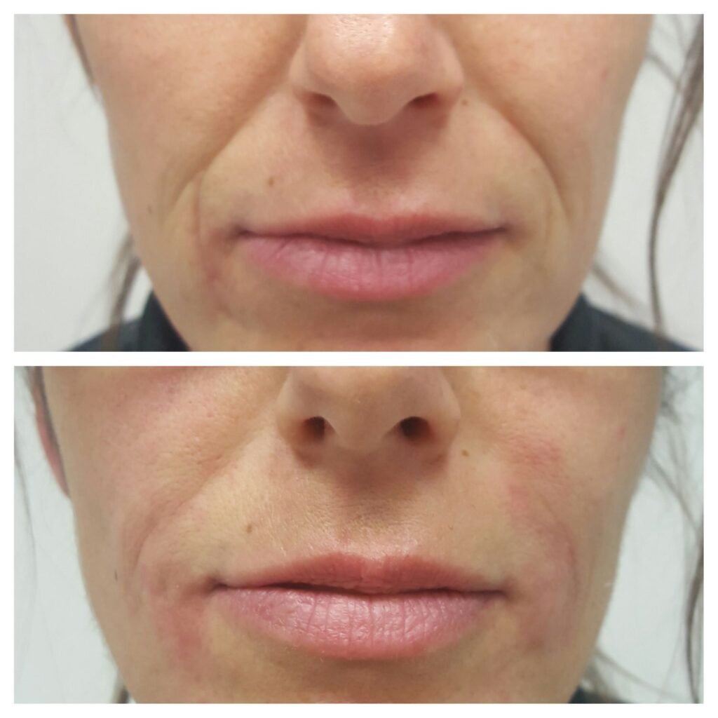 filler solchi nasogenieni 2