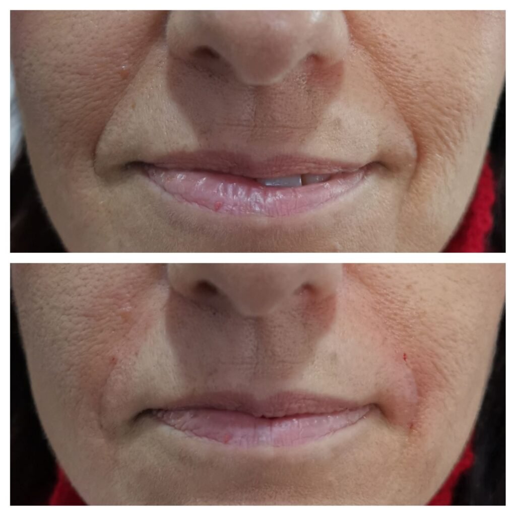 filler solchi nasogenieni 3