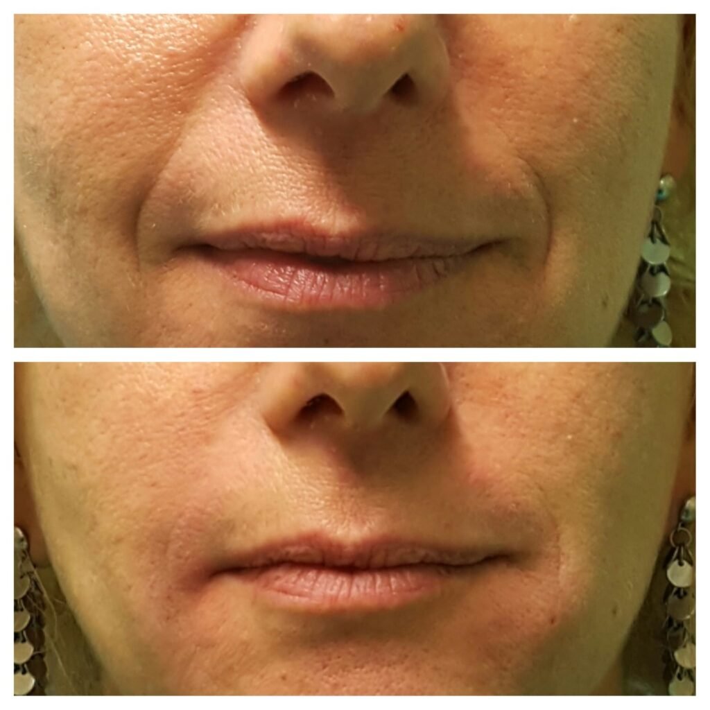 filler solchi nasogenieni 5