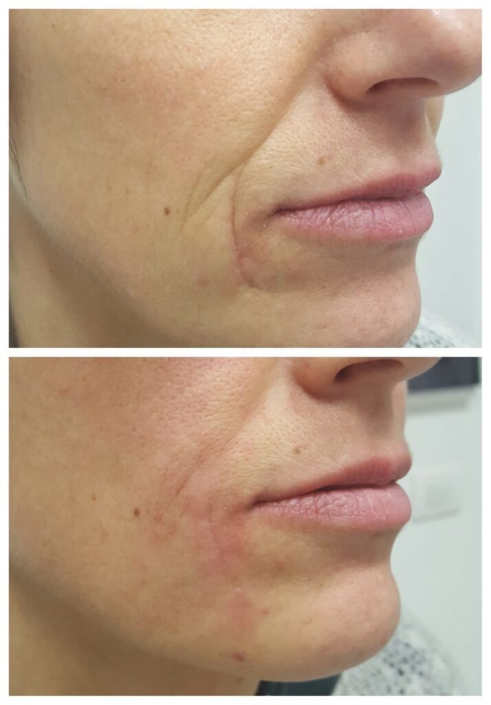filler solchi nasogenieni 6
