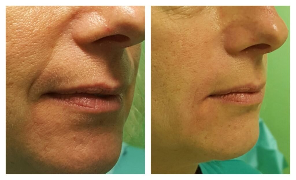 filler solchi nasogenieni 8