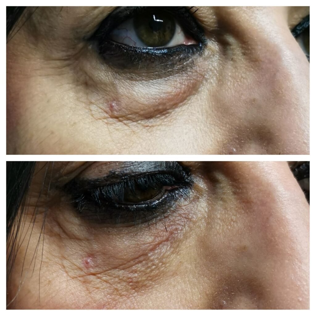 filler solco occhiaia 1