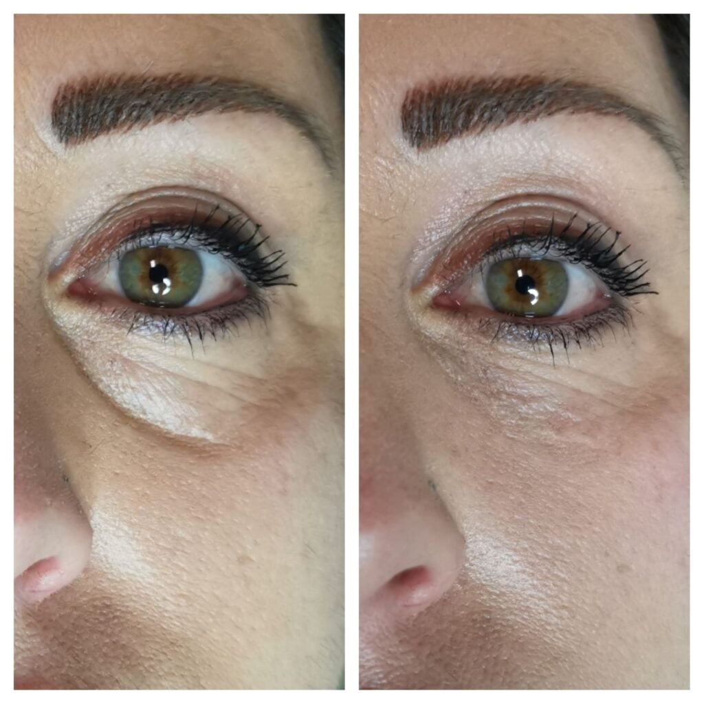 filler solco occhiaia 13