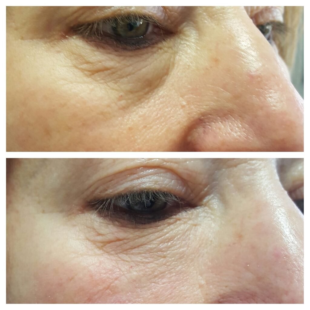 filler solco occhiaia 3