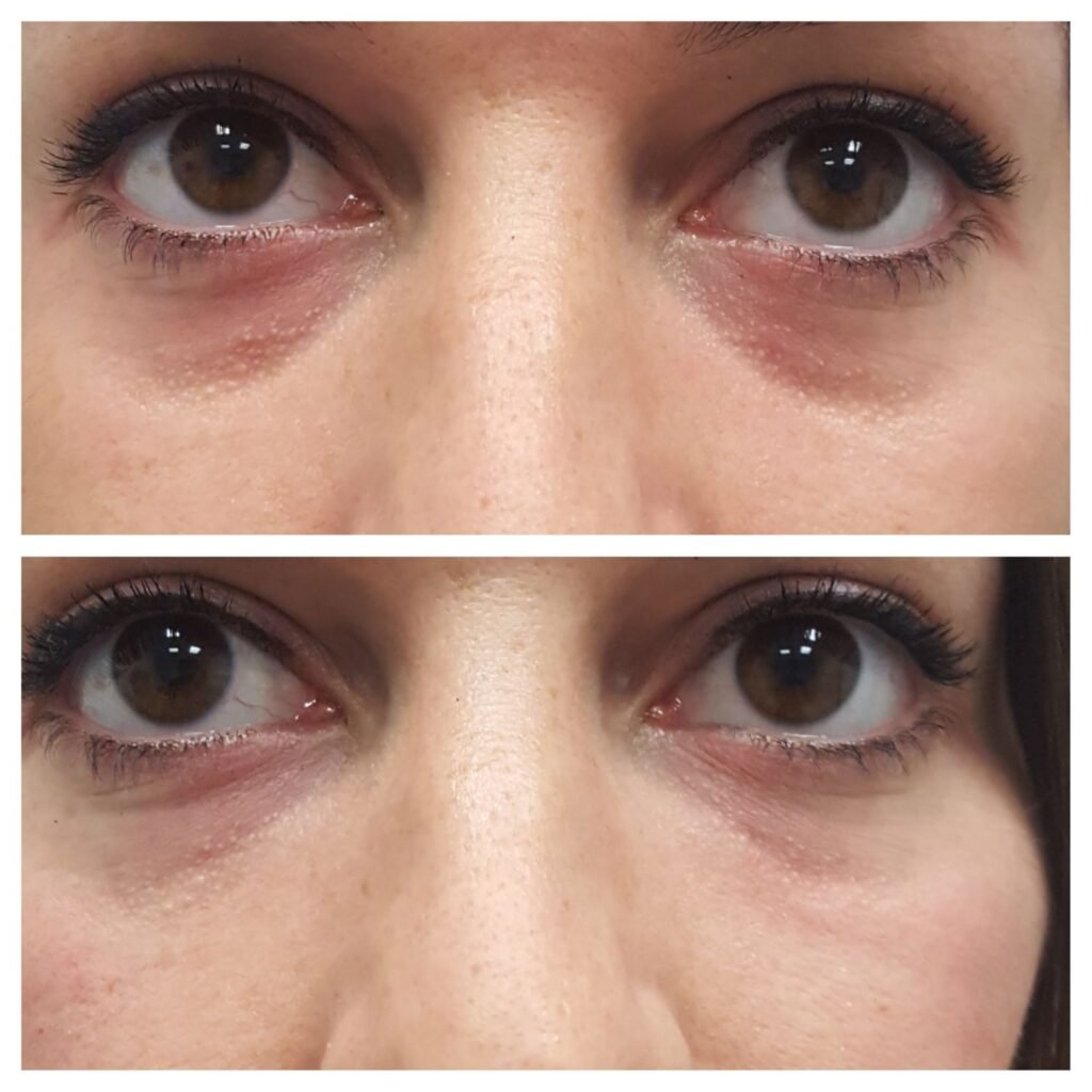 filler solco occhiaia 6