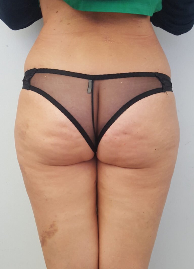 liposcultura 1post