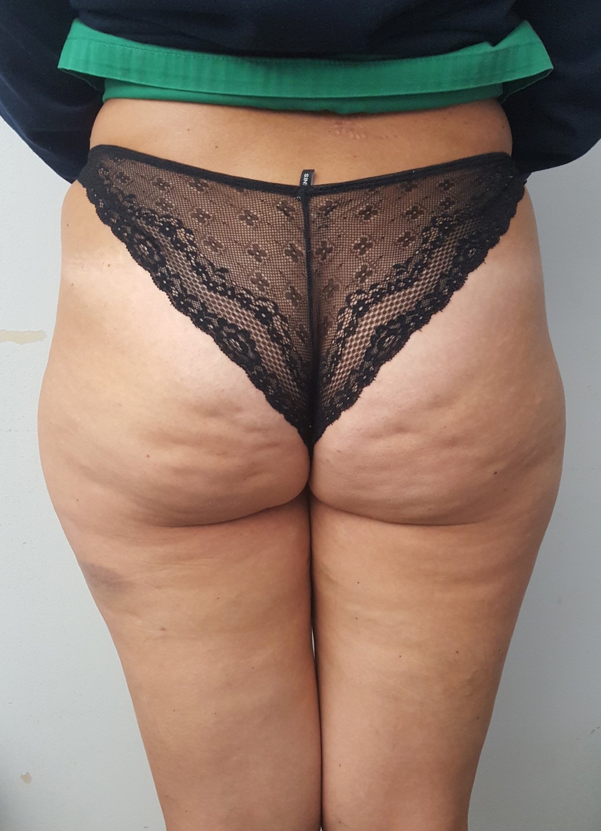 liposcultura 1pre