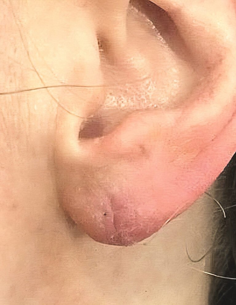 riparazione-lobi-auricolari post