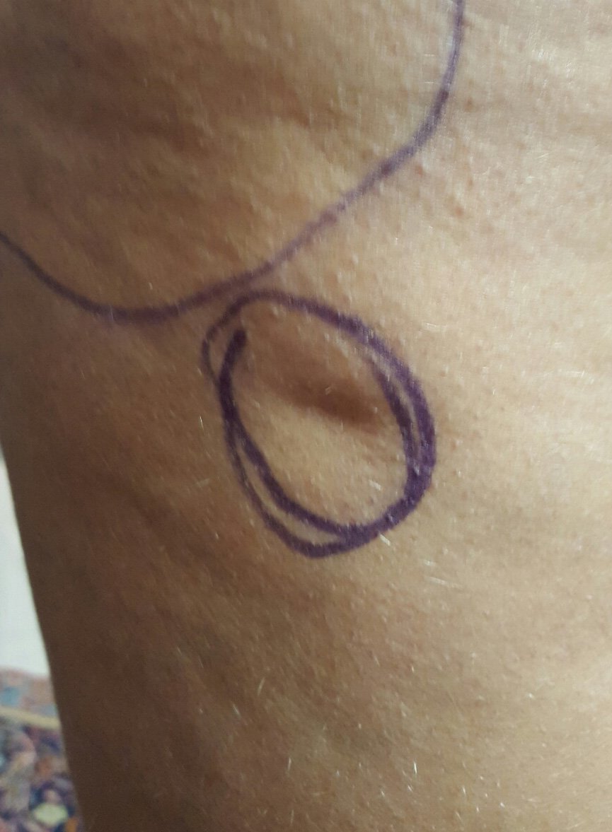 subcision pre